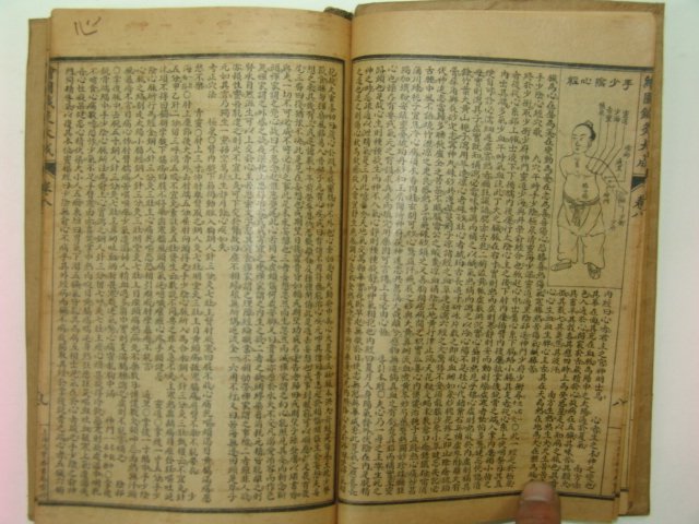 중국석판본 침구대성(針灸大成)권8~12 1책