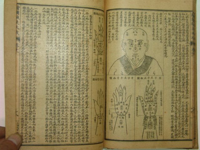 중국석판본 침구대성(針灸大成)권8~12 1책